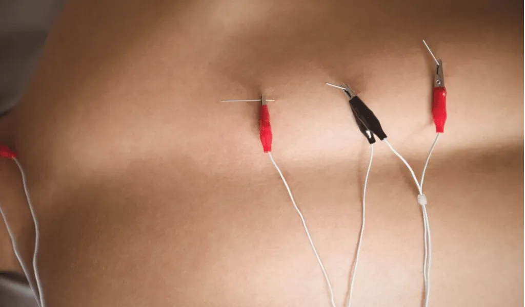 Acupuncture